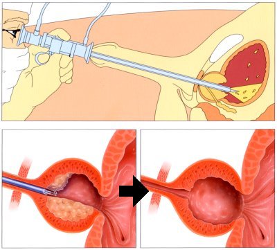 laroscopy